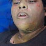 Entered the house and poured inflammable substance on the woman and set her on fire, referred to Delhi for treatment.