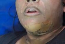 Entered the house and poured inflammable substance on the woman and set her on fire, referred to Delhi for treatment.