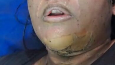 Entered the house and poured inflammable substance on the woman and set her on fire, referred to Delhi for treatment.