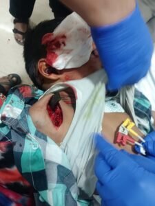 KGMU Neurosurgery Department created a miracle, gave a new life to an innocent child despite an iron rod stuck in his head